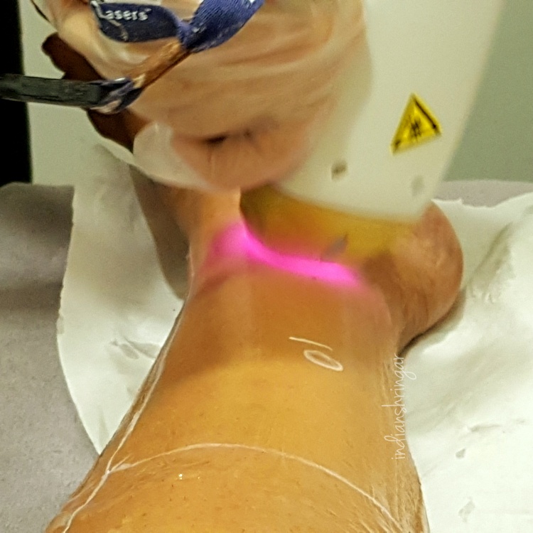 Laser hair removal with Soprano Ice Platinum at Therapie Clinic